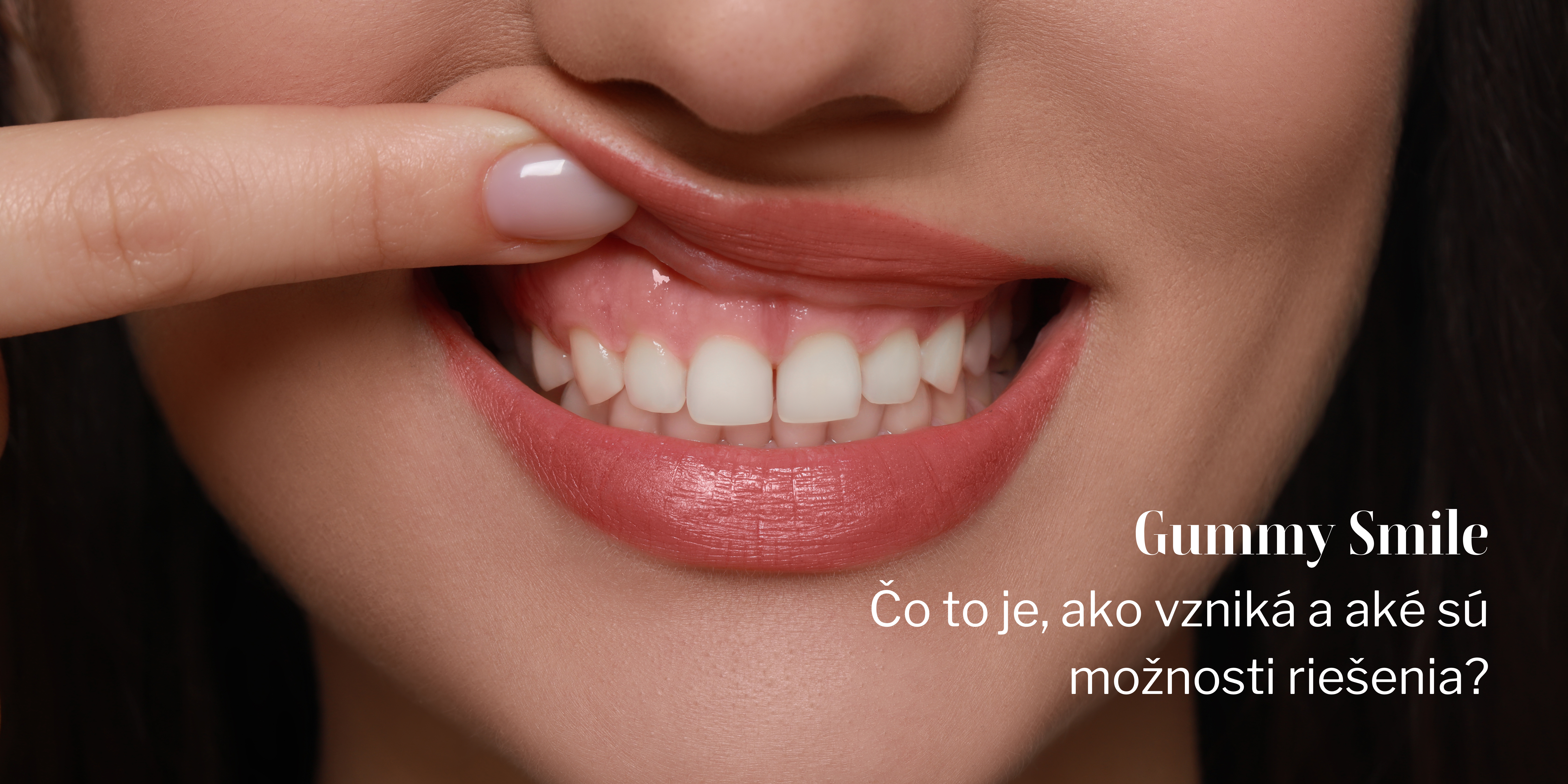 Gummy Smile – Čo to je, ako vzniká a ako sa dá vyriešiť?